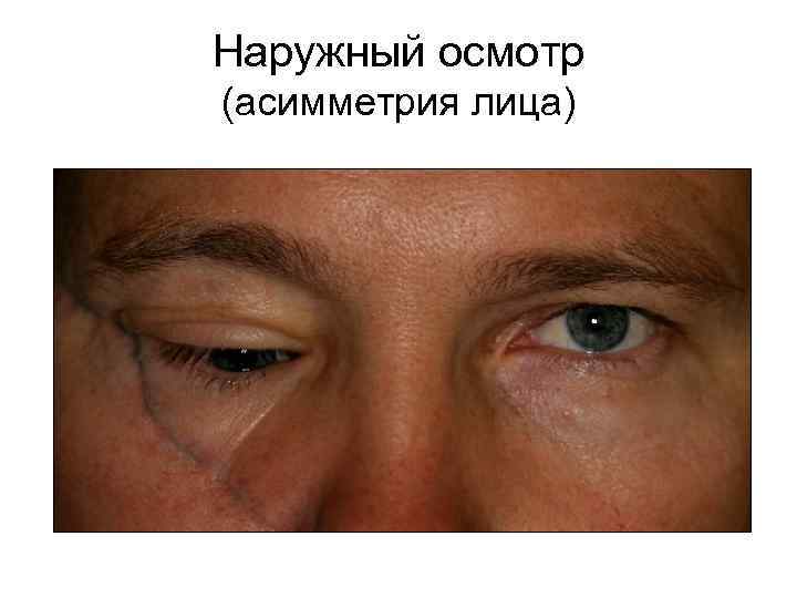 Наружный осмотр (асимметрия лица) 