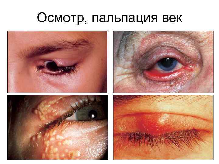 Осмотр, пальпация век 