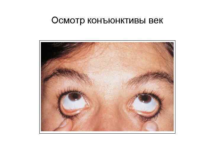 Осмотр конъюнктивы век 