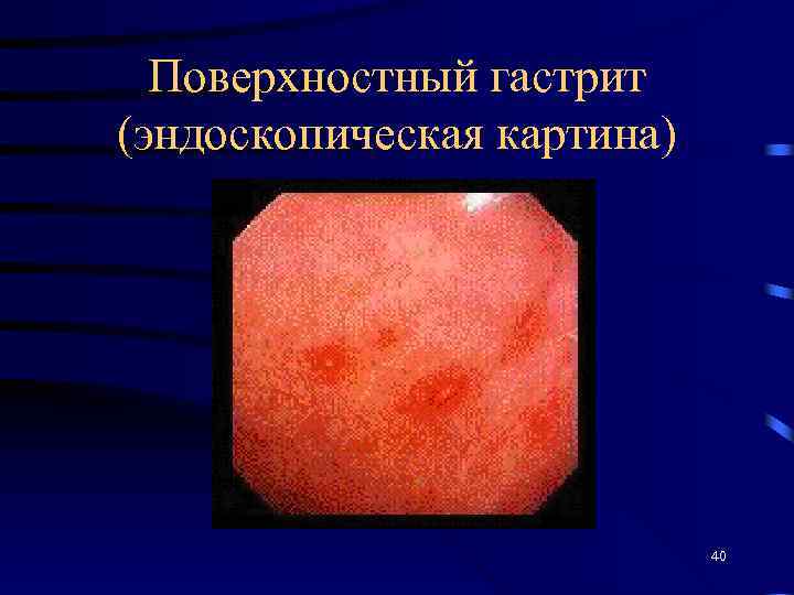 Поверхностный гастрит (эндоскопическая картина) 40 