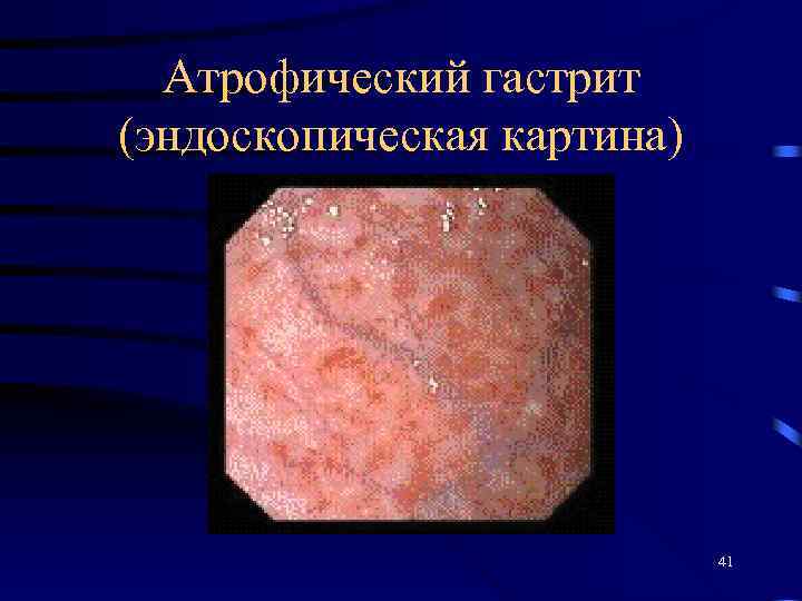 Атрофический гастрит (эндоскопическая картина) 41 