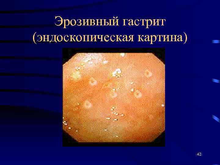 Эрозивный гастрит (эндоскопическая картина) 42 