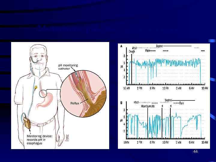 24 -часовое р. Н-мониторирование 44 