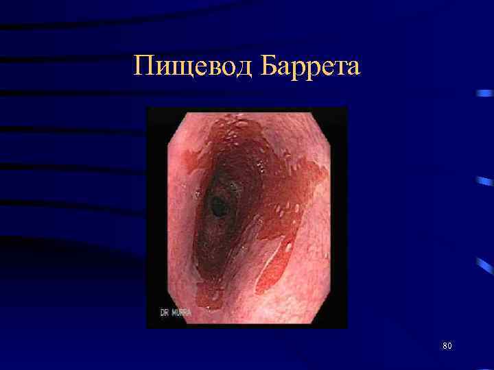 Пищевод Баррета 80 