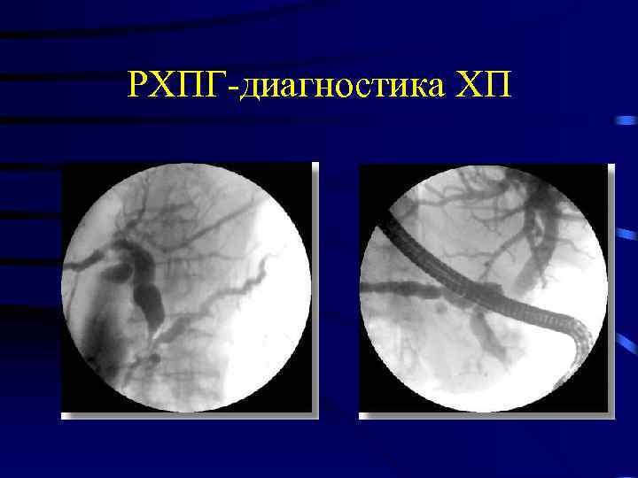 РХПГ-диагностика ХП 