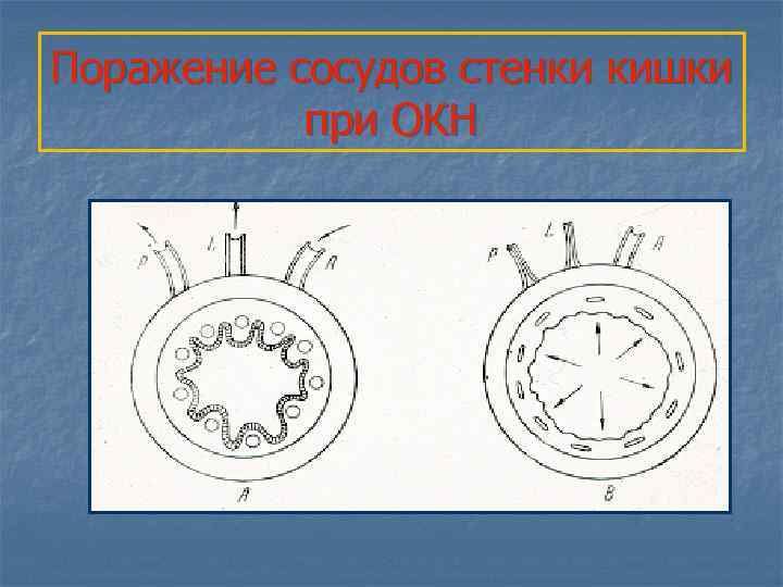 Поражение сосудов стенки кишки при ОКН 