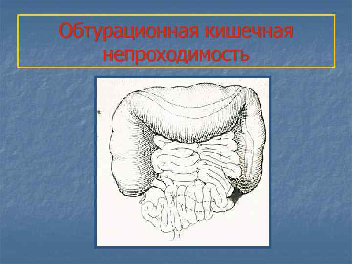 Обтурационная кишечная непроходимость 