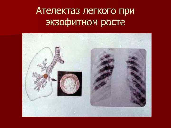 Ателектаз легкого при экзофитном росте 
