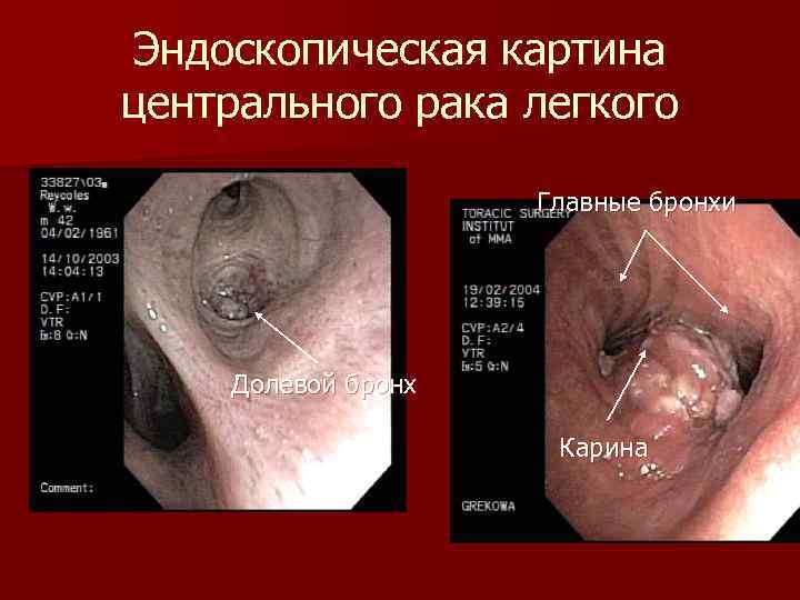 Эндоскопическая картина центрального рака легкого Главные бронхи Долевой бронх Карина 