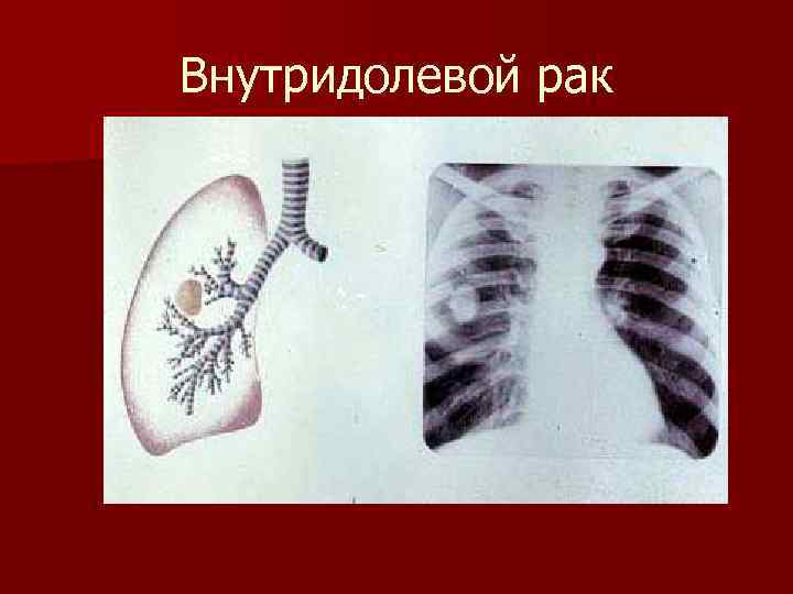 Внутридолевой рак 