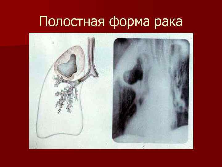 Полостная форма рака 