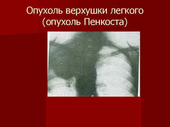 Опухоль верхушки легкого (опухоль Пенкоста) 