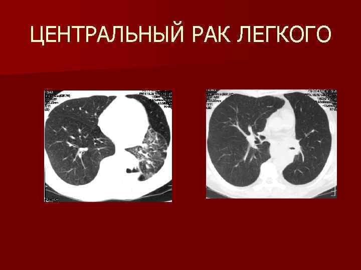 Центральный рак легкого. Плевра легких онкология. Пупковидное втяжение плевры. Опухоли лёгкого т2а т2б.