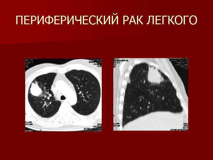 ПЕРИФЕРИЧЕСКИЙ РАК ЛЕГКОГО 