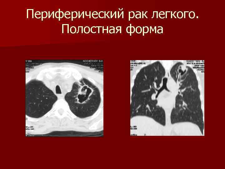 Периферический рак легкого. Полостная форма 