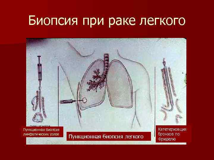 Биопсия при раке легкого Пункционная биопсия лимфатических узлов Пункционная биопсия легкого Катетеризация бронхов по