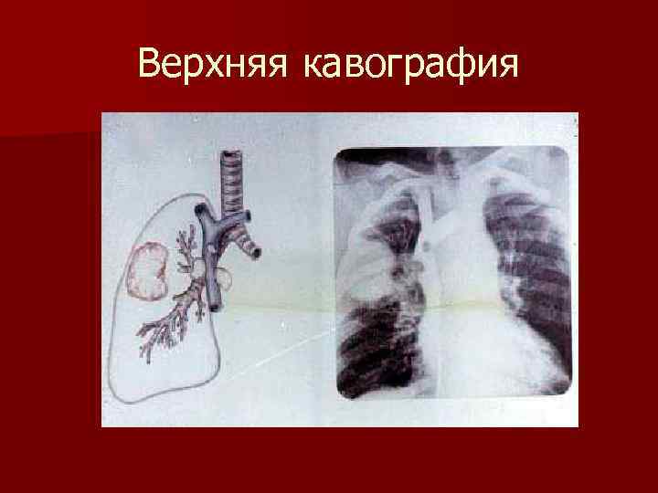 Верхняя кавография 