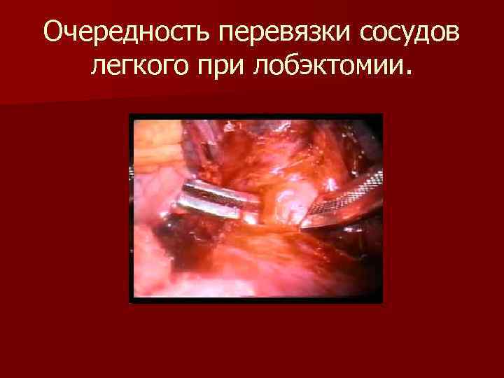 Очередность перевязки сосудов легкого при лобэктомии. 