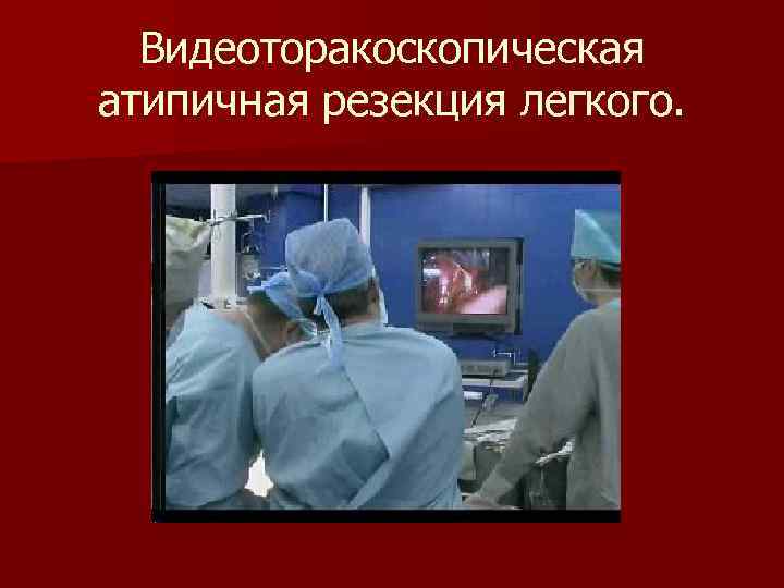Видеоторакоскопическая атипичная резекция легкого. 