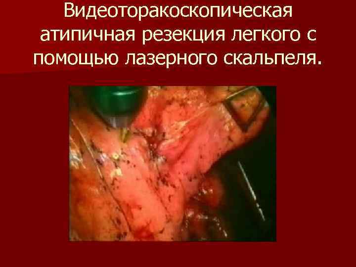 Видеоторакоскопическая атипичная резекция легкого c помощью лазерного скальпеля. 