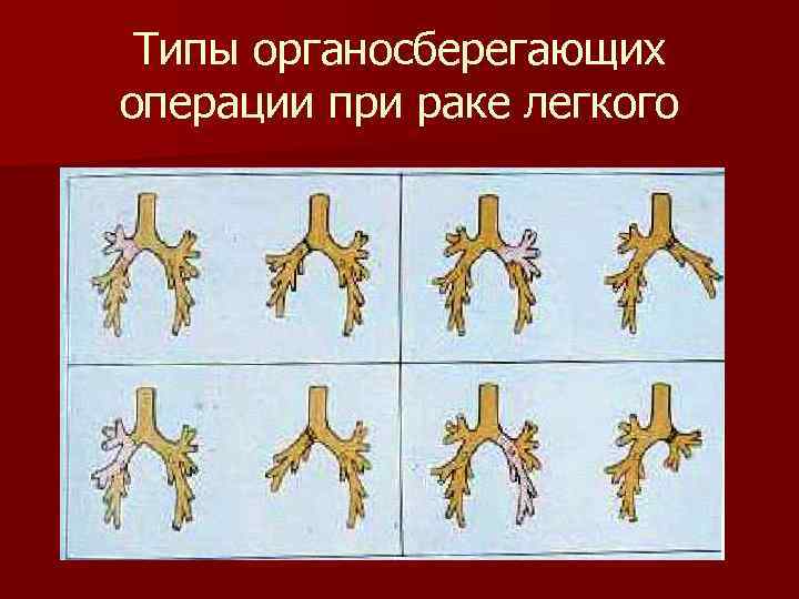Типы органосберегающих операции при раке легкого 