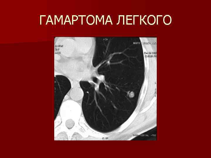 ГАМАРТОМА ЛЕГКОГО 