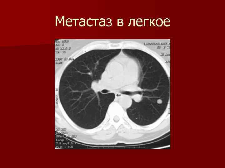 Метастаз в легкое 