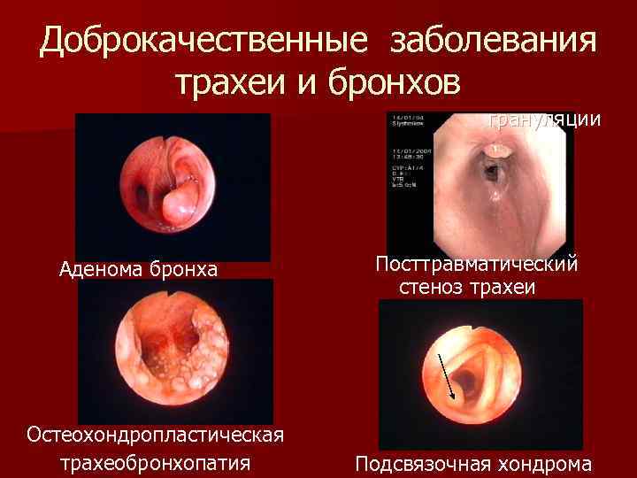 Доброкачественные заболевания трахеи и бронхов грануляции Аденома бронха Остеохондропластическая трахеобронхопатия Посттравматический стеноз трахеи Подсвязочная