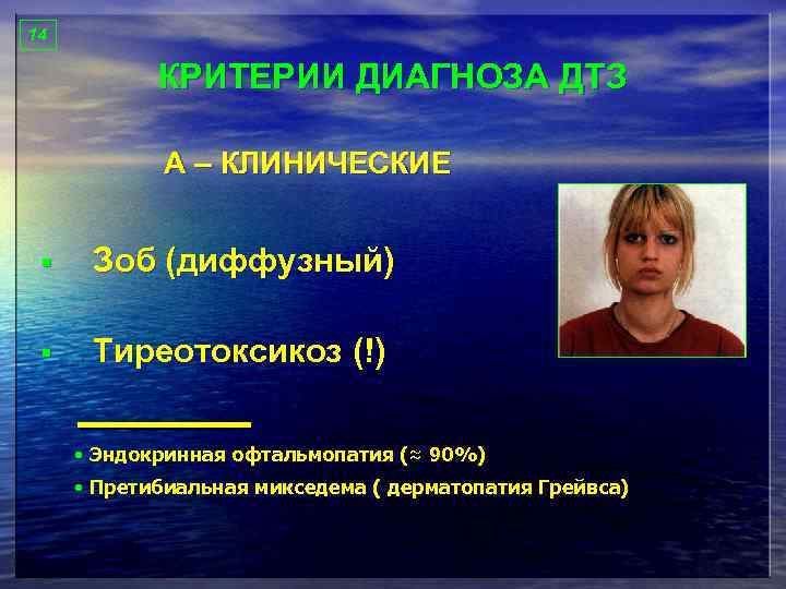 14 КРИТЕРИИ ДИАГНОЗА ДТЗ А – КЛИНИЧЕСКИЕ § Зоб (диффузный) § Тиреотоксикоз (!) •