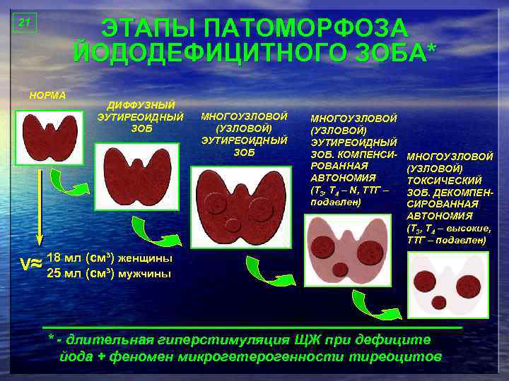 ЭТАПЫ ПАТОМОРФОЗА ЙОДОДЕФИЦИТНОГО ЗОБА* 21 НОРМА ДИФФУЗНЫЙ ЭУТИРЕОИДНЫЙ ЗОБ МНОГОУЗЛОВОЙ (УЗЛОВОЙ) ЭУТИРЕОИДНЫЙ ЗОБ. КОМПЕНСИРОВАННАЯ