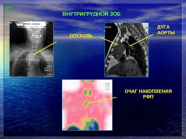 27 ВНУТРИГРУДНОЙ ЗОБ ОПУХОЛЬ ДУГА АОРТЫ ОЧАГ НАКОПЛЕНИЯ РФП 