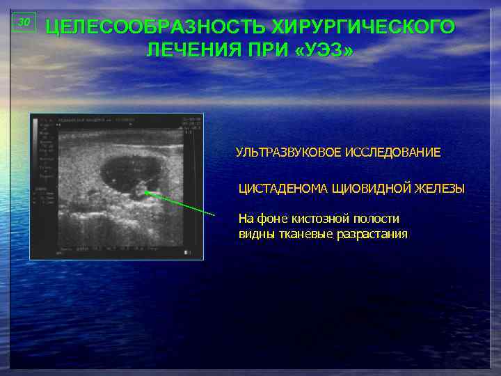 30 ЦЕЛЕСООБРАЗНОСТЬ ХИРУРГИЧЕСКОГО ЛЕЧЕНИЯ ПРИ «УЭЗ» УЛЬТРАЗВУКОВОЕ ИССЛЕДОВАНИЕ ЦИСТАДЕНОМА ЩИОВИДНОЙ ЖЕЛЕЗЫ На фоне кистозной