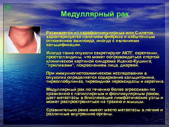 35 Медуллярный рак Развивается из парафолликулярных или С-клеток, характеризуется наличием фиброза и избыточным отложением