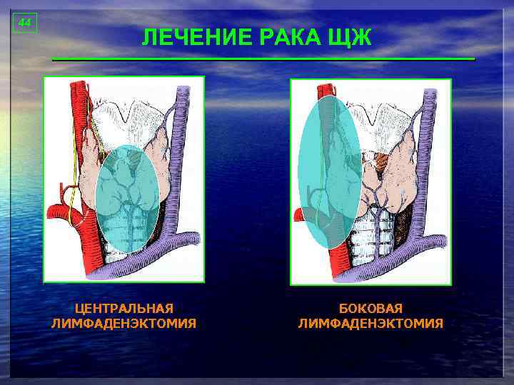 44 ЛЕЧЕНИЕ РАКА ЩЖ ЦЕНТРАЛЬНАЯ ЛИМФАДЕНЭКТОМИЯ БОКОВАЯ ЛИМФАДЕНЭКТОМИЯ 