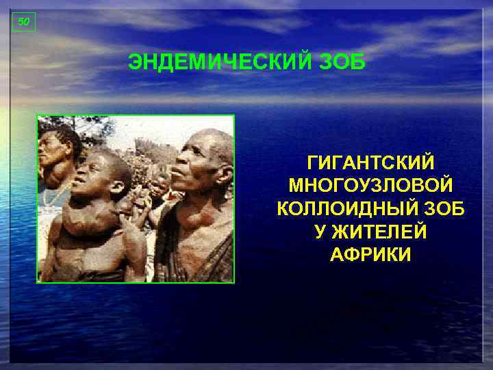 50 ЭНДЕМИЧЕСКИЙ ЗОБ ГИГАНТСКИЙ МНОГОУЗЛОВОЙ КОЛЛОИДНЫЙ ЗОБ У ЖИТЕЛЕЙ АФРИКИ 