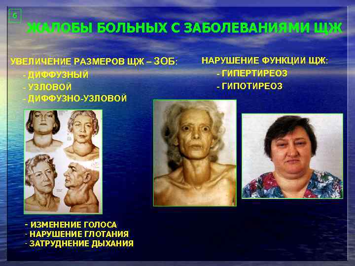 6 ЖАЛОБЫ БОЛЬНЫХ С ЗАБОЛЕВАНИЯМИ ЩЖ УВЕЛИЧЕНИЕ РАЗМЕРОВ ЩЖ – ЗОБ: - ДИФФУЗНЫЙ -