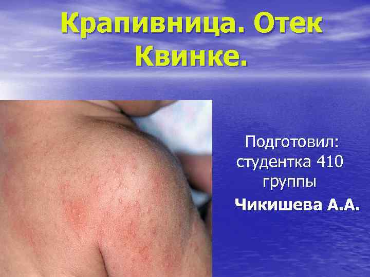 Крапивница. Отек Квинке. Подготовил: студентка 410 группы Чикишева А. А. 