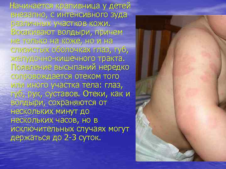 Начинается крапивница у детей внезапно, с интенсивного зуда различных участков кожи. Вскакивают волдыри, причем
