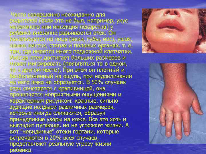 Часто совершенно неожиданно для родителей (если это не был, например, укус насекомого или инъекция