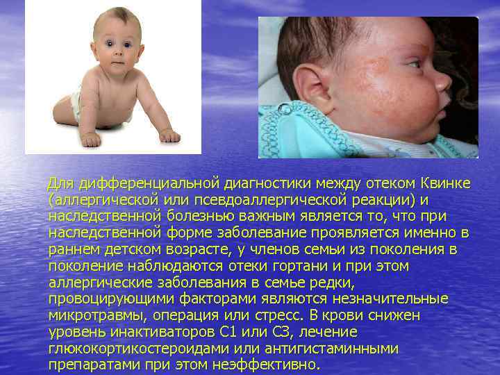 Для дифференциальной диагностики между отеком Квинке (аллергической или псевдоаллергической реакции) и наследственной болезнью важным