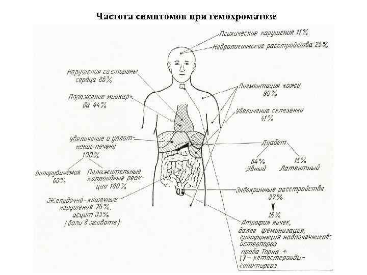 Частота симптомов при гемохроматозе 