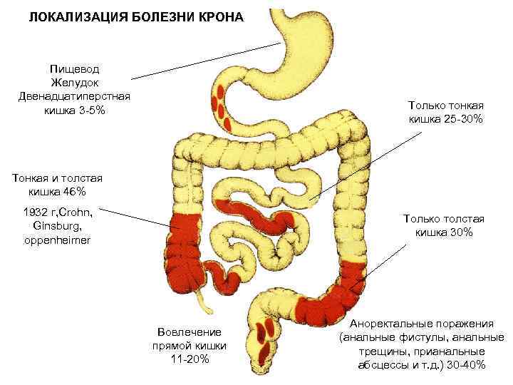 Недостаточность илеоцекального клапана кишечника