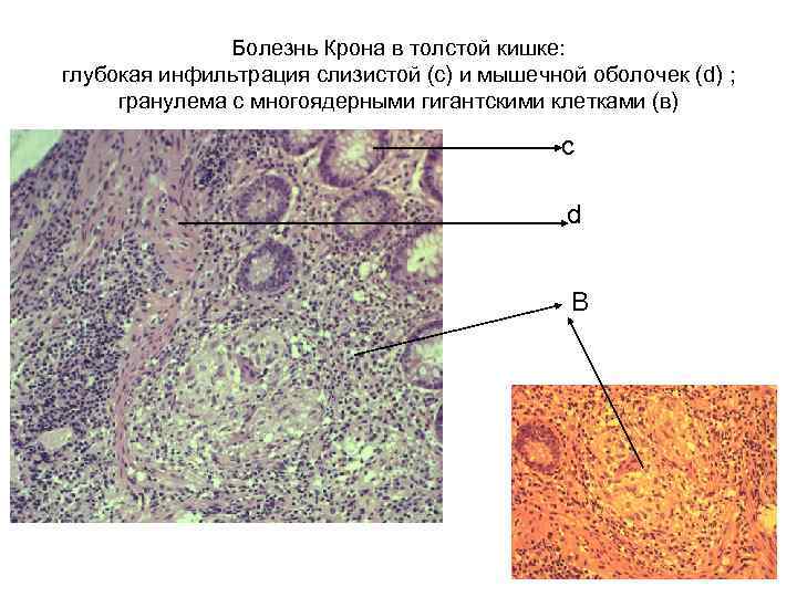 Болезнь Крона в толстой кишке: глубокая инфильтрация слизистой (с) и мышечной оболочек (d) ;