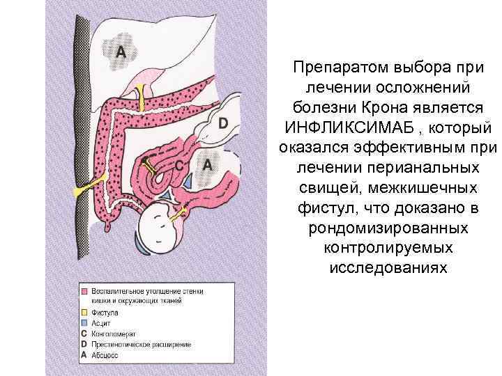 Препаратом выбора при лечении осложнений болезни Крона является ИНФЛИКСИМАБ , который оказался эффективным при