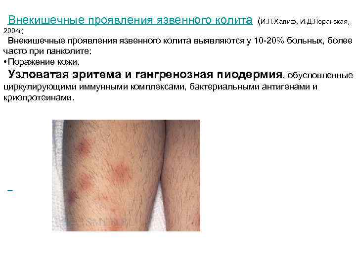 Внекишечные проявления язвенного колита (И. Л. Халиф, И. Д. Лоранская, 2004 г) Внекишечные проявления
