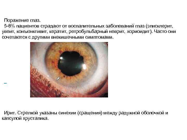 Поражение глаз. 5 -8% пациентов страдают от воспалительных заболеваний глаз (эписклерит, увеит, конъюнктивит, кератит,