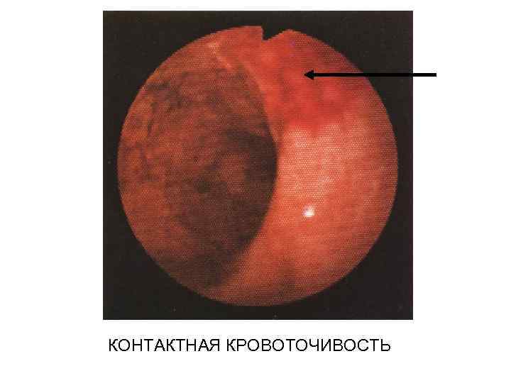 КОНТАКТНАЯ КРОВОТОЧИВОСТЬ 