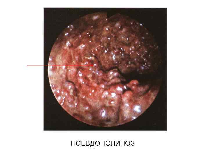 ПСЕВДОПОЛИПОЗ 