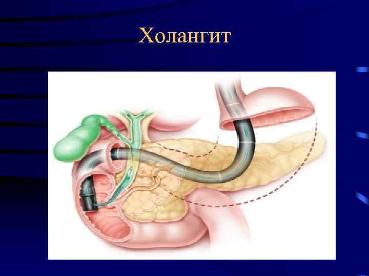 Холангит. Холедохолитиаз острый холангит. Воспаление желчных протоков. Воспаление желчного протока.