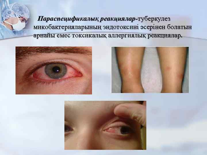 Параспецификалық реакциялар-туберкулез микобактерияларының эндотоксині әсерінен болатын арнайы емес токсикалық аллергиялық реакциялар. 